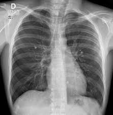 Pathologies kystiques pulmonaires de l’enfant